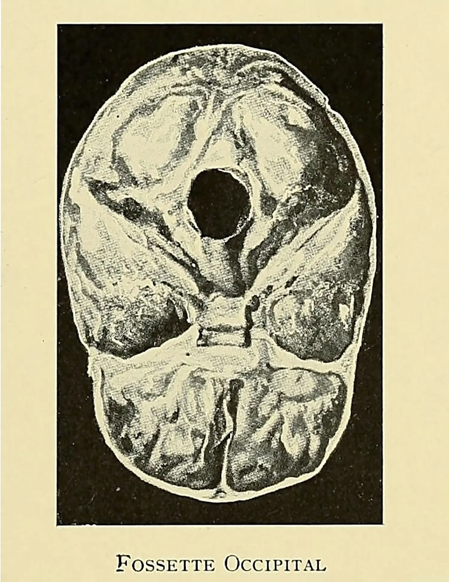 A hand-painted brain cross-section subtitled “Fossette Occipital.”