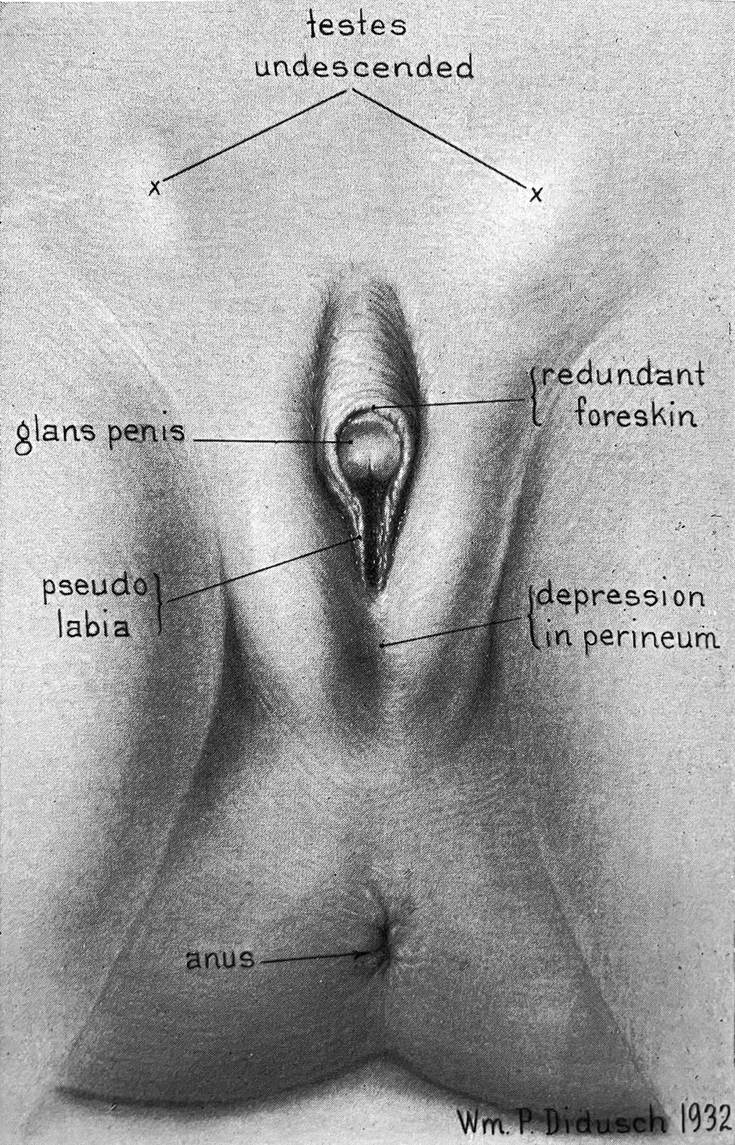 Medical illustration accompanying the case study portrays “testes undescended,” “glans penis,” “redundant foreskin,” and “pseudo labia.” Medical illustration accompanying the case study portrays “testes undescended,” “glans penis,” “redundant foreskin,” and “pseudo labia.”