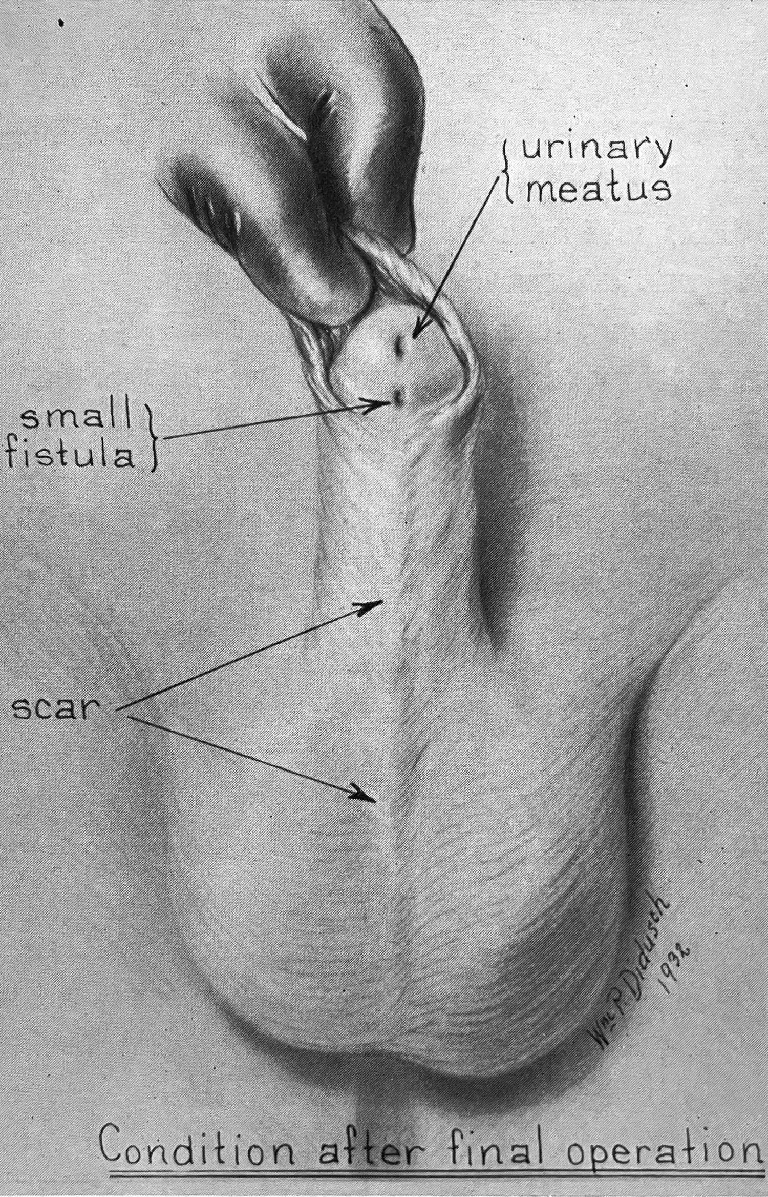 Medical illustration titled “Condition after final operation” shows a reconstructed penis, with annotations pointing to the “urinary meatus,” “scar,” and “small fistula.” Medical illustration titled “Condition after final operation” shows a reconstructed penis, with annotations pointing to the “urinary meatus,” “scar,” and “small fistula.”