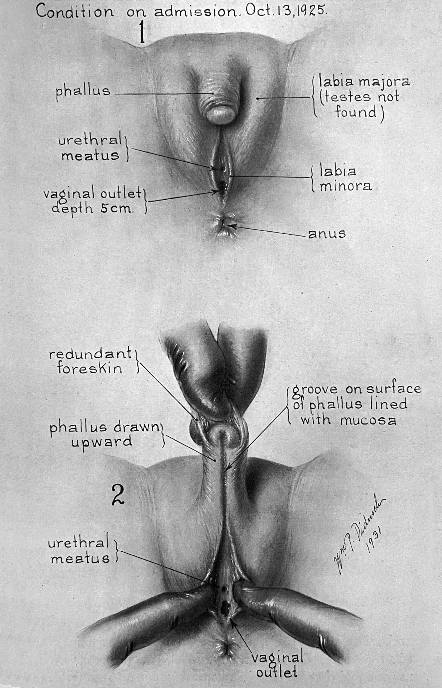Two-part medical illustration titled “Condition on admission, Oct. 13, 1925” shows two views of the patient’s genitalia. Annotations point to the “phallus,” “vaginal outlet,” and “labia majora (testes not found)” among others. Two-part medical illustration titled “Condition on admission, Oct. 13, 1925” shows two views of the patient’s genitalia. Annotations point to the “phallus,” “vaginal outlet,” and “labia majora (testes not found)” among others.